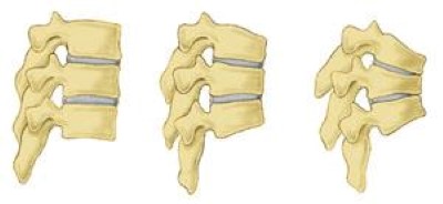 Osteoporosis