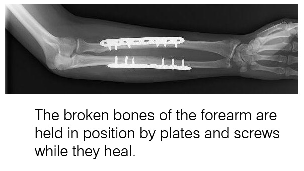 Broken Bones