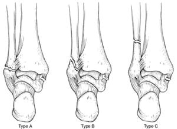 Different levels of lateral malleolus fractures