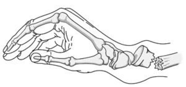 Distal Radius