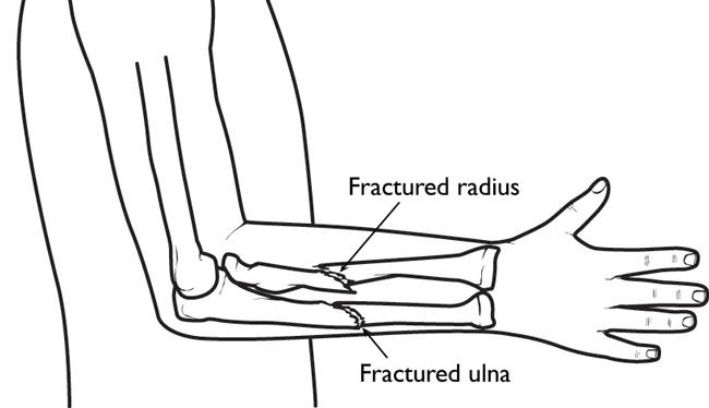 Fractures in both bones of the forearm