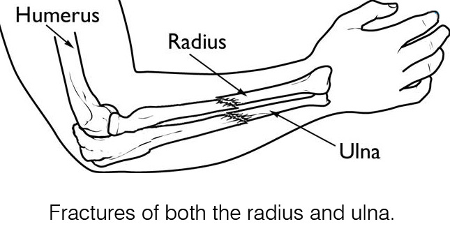 Fractures of both the radius and ulna