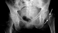 Hip Fractures