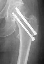 Repair of an intracapsular fracture with individual screws.
