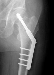 Repair of an intracapsular fracture with a single compression hip screw