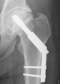 Repair of an intracapsular fracture with individual screws.