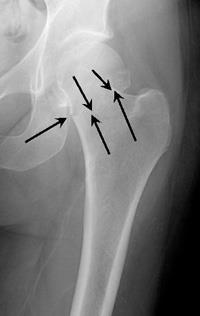 Stable Impacted Fracture