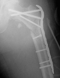 Subtrochanteric Fracture