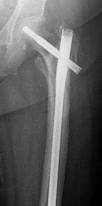 Subtrochanteric Fracture